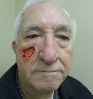 Skin Cancer Reconstruction Case 3632 Before Photo Skin Cancer Reconstruction