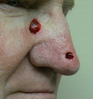 Skin Cancer Reconstruction Case 3635 Before Photo Skin Cancer Reconstruction