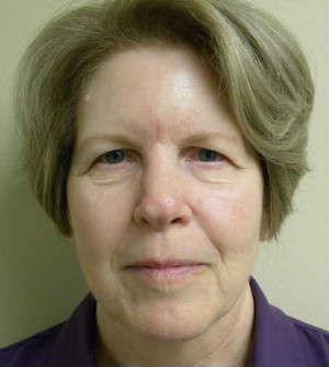 Skin Cancer Reconstruction Case 3638 After Photo Skin Cancer Reconstruction