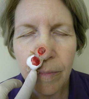 Skin Cancer Reconstruction Case 3638 Before Photo Skin Cancer Reconstruction