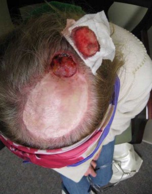 Skin Cancer Reconstruction Case 3641 Before Photo Skin Cancer Reconstruction