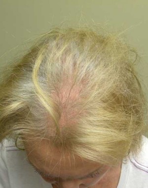 Skin Cancer Reconstruction Case 3641 After Photo Skin Cancer Reconstruction