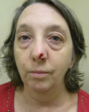 Skin Cancer Reconstruction Case 3644 Before Photo Skin Cancer Reconstruction