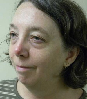 Skin Cancer Reconstruction Case 3644 After Photo Skin Cancer Reconstruction