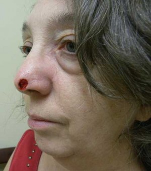 Skin Cancer Reconstruction Case 3644 Before Photo Skin Cancer Reconstruction