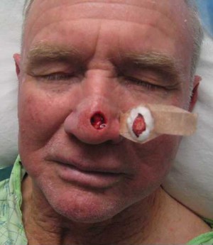 Skin Cancer Reconstruction Case 3649 Before Photo Skin Cancer Reconstruction