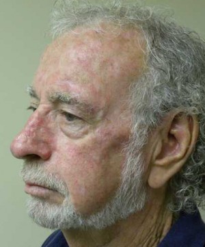 Skin Cancer Reconstruction Case 3652 After Photo Skin Cancer Reconstruction