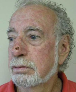 Skin Cancer Reconstruction Case 3652 Before Photo Skin Cancer Reconstruction