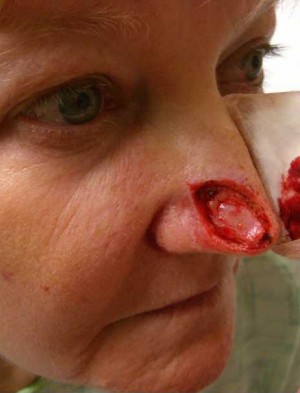 Skin Cancer Reconstruction Case 3658 Before Photo Skin Cancer Reconstruction