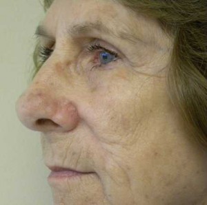 Skin Cancer Reconstruction Case 3664 After Photo Skin Cancer Reconstruction