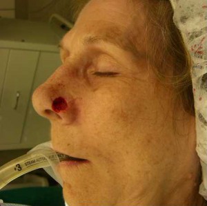 Skin Cancer Reconstruction Case 3664 Before Photo Skin Cancer Reconstruction