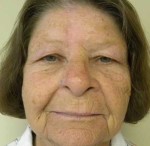 Skin Cancer Reconstruction