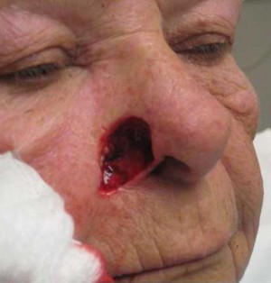 Skin Cancer Reconstruction Case 3667 Before Photo Skin Cancer Reconstruction