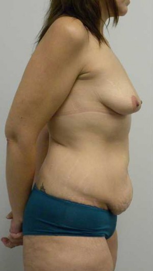 Mommy Makeover Case 3696 Before Photo Mommy Makeover