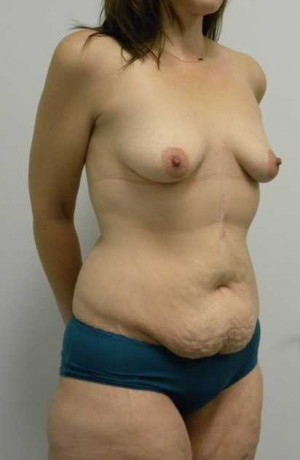Mommy Makeover Case 3696 Before Photo Mommy Makeover
