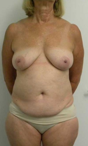 Mommy Makeover Case 3703 Before Photo Mommy Makeover