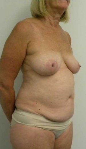 Mommy Makeover Case 3703 Before Photo Mommy Makeover