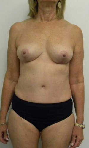 Mommy Makeover Case 3703 After Photo Mommy Makeover