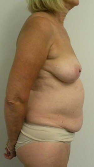 Mommy Makeover Case 3703 Before Photo Mommy Makeover