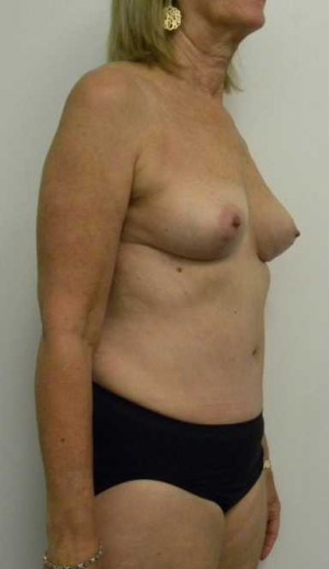 Mommy Makeover Case 3703 After Photo Mommy Makeover