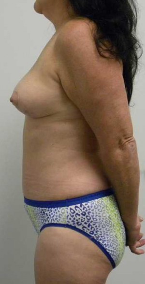 Mommy Makeover Case 3724 After Photo Mommy Makeover