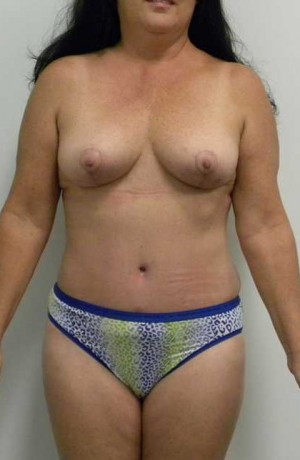 Mommy Makeover Case 3724 After Photo Mommy Makeover