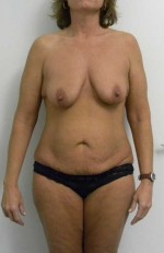 Mommy Makeover