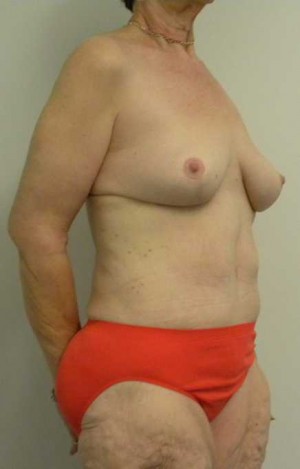 Mommy Makeover Case 3738 After Photo Mommy Makeover