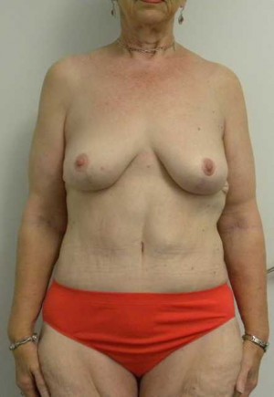 Mommy Makeover Case 3738 After Photo Mommy Makeover