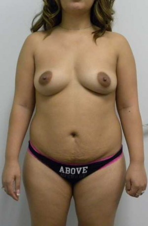 Mommy Makeover Case 3752 Before Photo Mommy Makeover