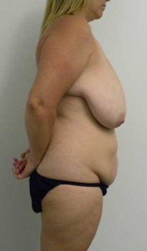 Mommy Makeover Case 3773 Before Photo Mommy Makeover