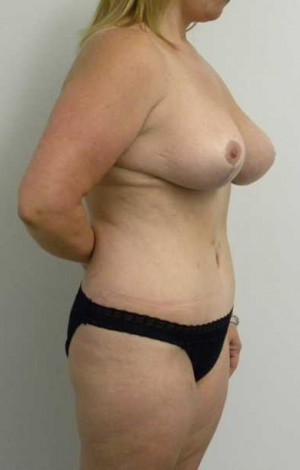 Mommy Makeover Case 3773 After Photo Mommy Makeover