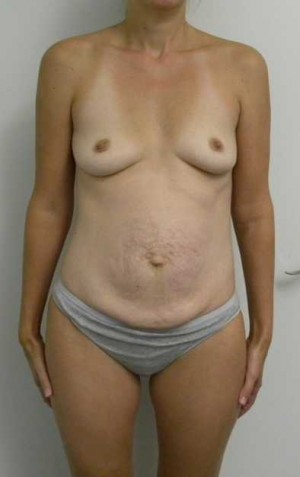 Mommy Makeover Case 3780 Before Photo Mommy Makeover
