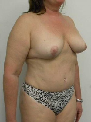 Mommy Makeover Case 3794 After Photo Mommy Makeover