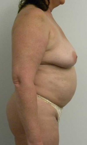 Mommy Makeover Case 3794 Before Photo Mommy Makeover
