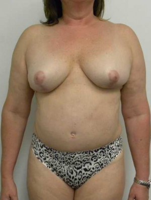 Mommy Makeover Case 3794 After Photo Mommy Makeover