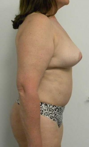 Mommy Makeover Case 3794 After Photo Mommy Makeover