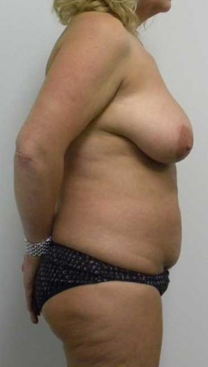 Mommy Makeover Case 3808 Before Photo Mommy Makeover