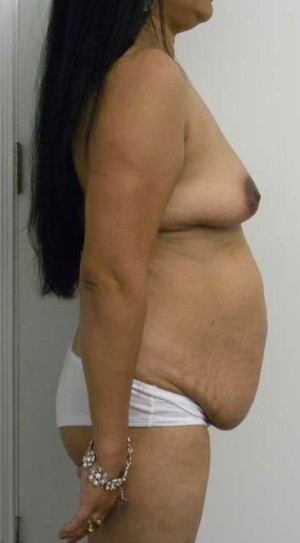 Mommy Makeover Case 3815 Before Photo Mommy Makeover