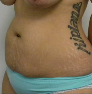 Tummy tuck (Abdominoplasty) Case 3843 Before Photo Tummy tuck (Abdominoplasty)