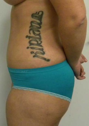 Tummy tuck (Abdominoplasty) Case 3843 After Photo Tummy tuck (Abdominoplasty)