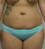 Tummy tuck (Abdominoplasty)