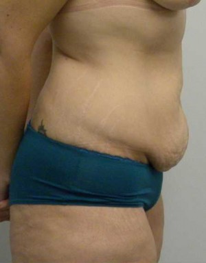 Tummy tuck (Abdominoplasty)