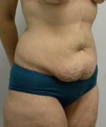 Tummy tuck (Abdominoplasty)