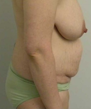 Tummy tuck (Abdominoplasty) Case 3857 Before Photo Tummy tuck (Abdominoplasty)