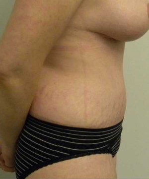 Tummy tuck (Abdominoplasty)