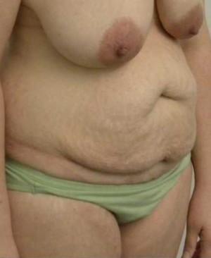 Tummy tuck (Abdominoplasty) Case 3857 Before Photo Tummy tuck (Abdominoplasty)