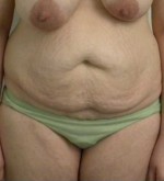 Tummy tuck (Abdominoplasty)