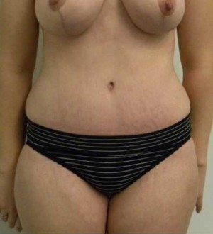 Tummy tuck (Abdominoplasty)