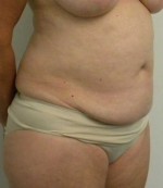 Tummy tuck (Abdominoplasty)